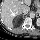 Adrenal imaging: A three-category approach to managing incidentalomas